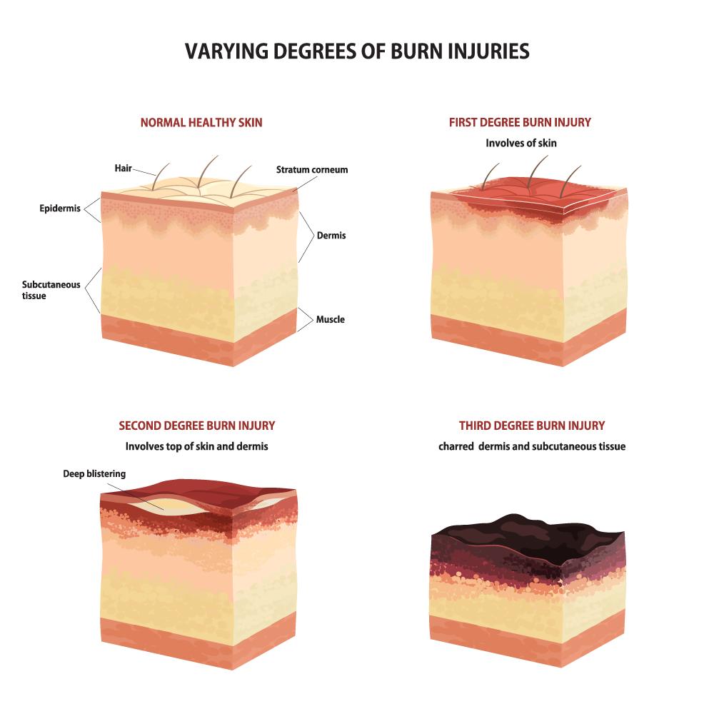 Initial Management of Thermal Burn Injuries