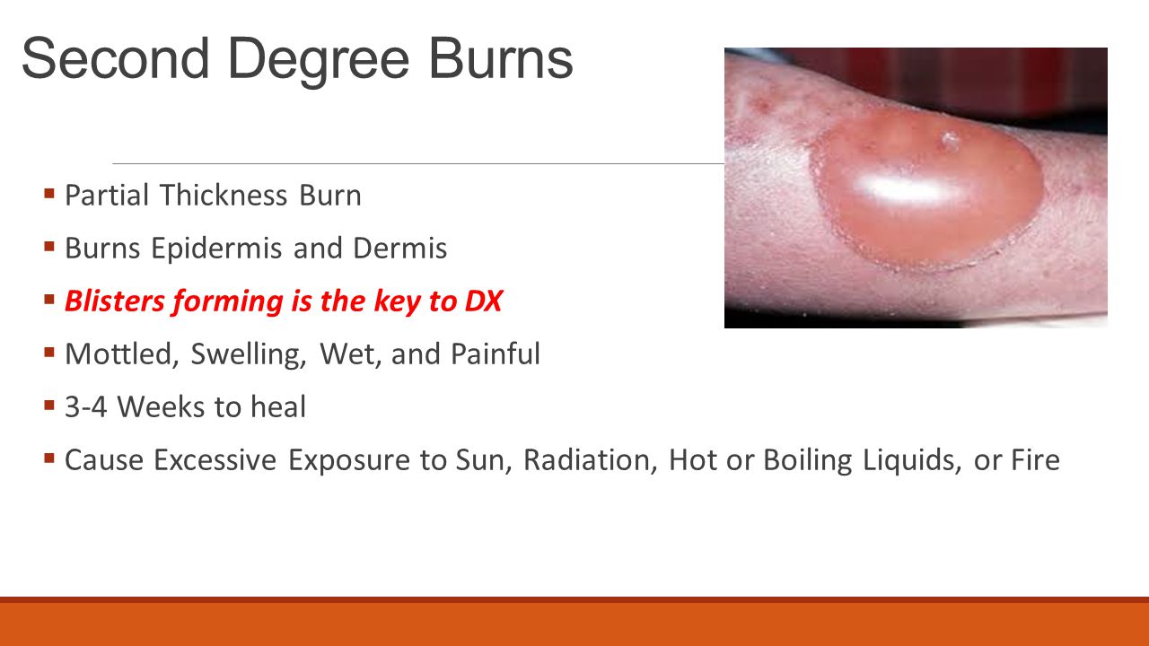 How To Treat A 2nd Degree Burn